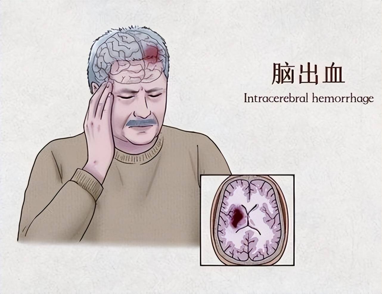 中医食疗：滋养脑出血后遗症患者的身心
