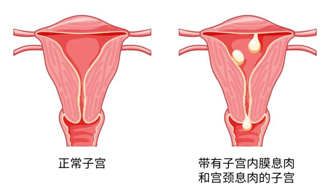 子宫内膜息肉需要治疗吗丨西安邱学华妇科(图2)