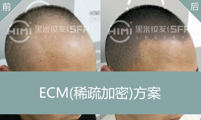 M型发际线纹发，重塑发际线，头顶稀疏加密