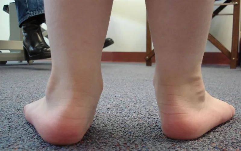 最新的儿童青少年肥胖标准出炉:性别年龄别BMI指数标准