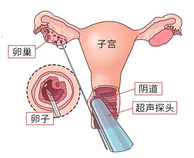 广州供卵试管技术的现状与挑战:伦理与法律的双重考量 广州供卵试管技术的现状与挑战:伦理与法律的双重考量