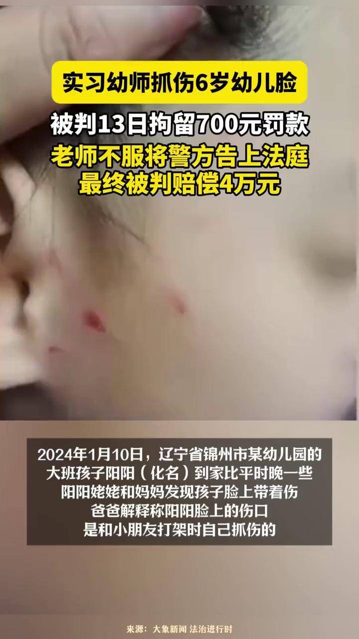 实习幼师抓伤6岁幼儿脸 被判13日拘留700元罚款