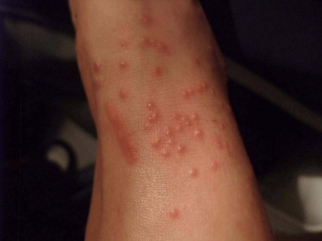 夜里痒到怀疑人生,原来是有虫子在我皮肤里挖洞产卵