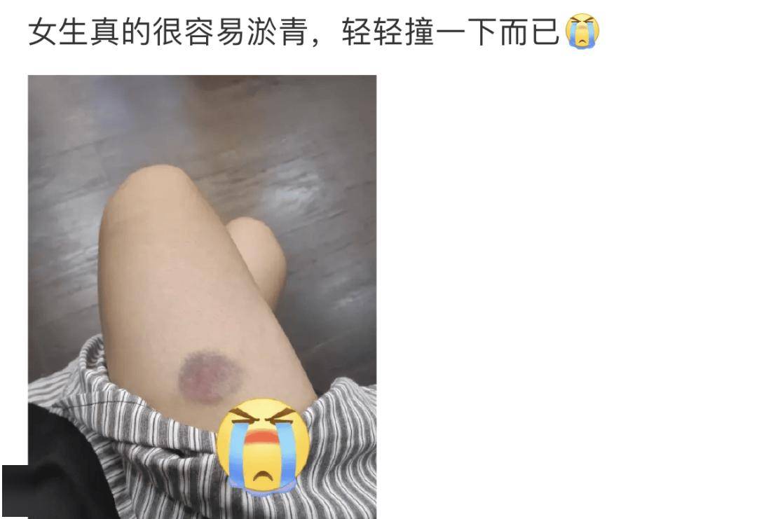 【揭秘】为啥女朋友身上，总是出现莫名的淤青？