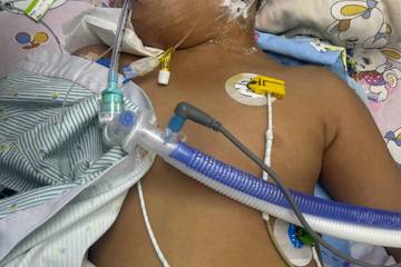 3岁男童因打呼噜入院做手术昏迷不醒 被初步诊断可能脑死亡