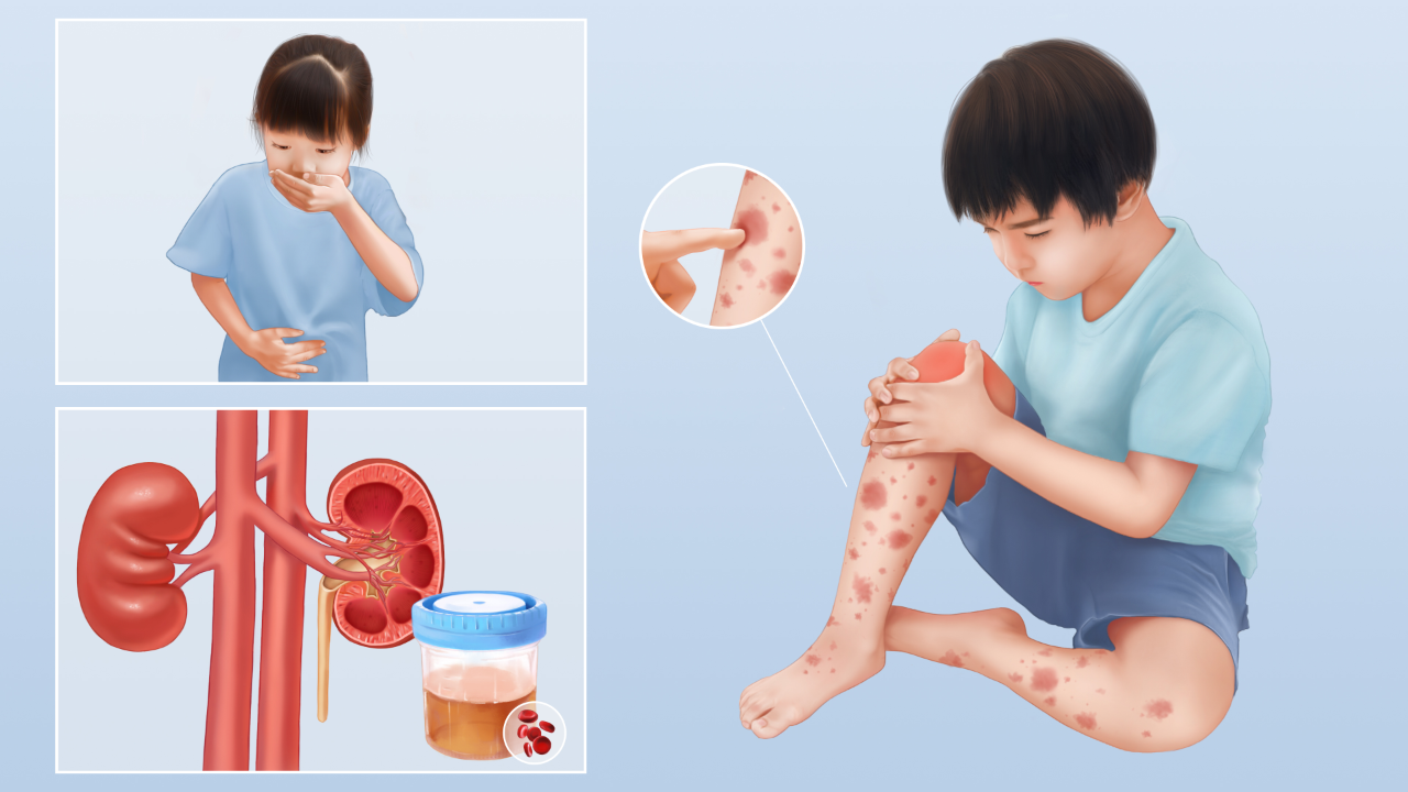 过敏性紫癜是一种全身性出血性的毛细血管炎,是由于免疫紊乱,血管毒素