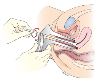 以筛查宫颈癌前病变和宫颈癌,同时可对人乳头瘤病毒(hpv)基因检测,以
