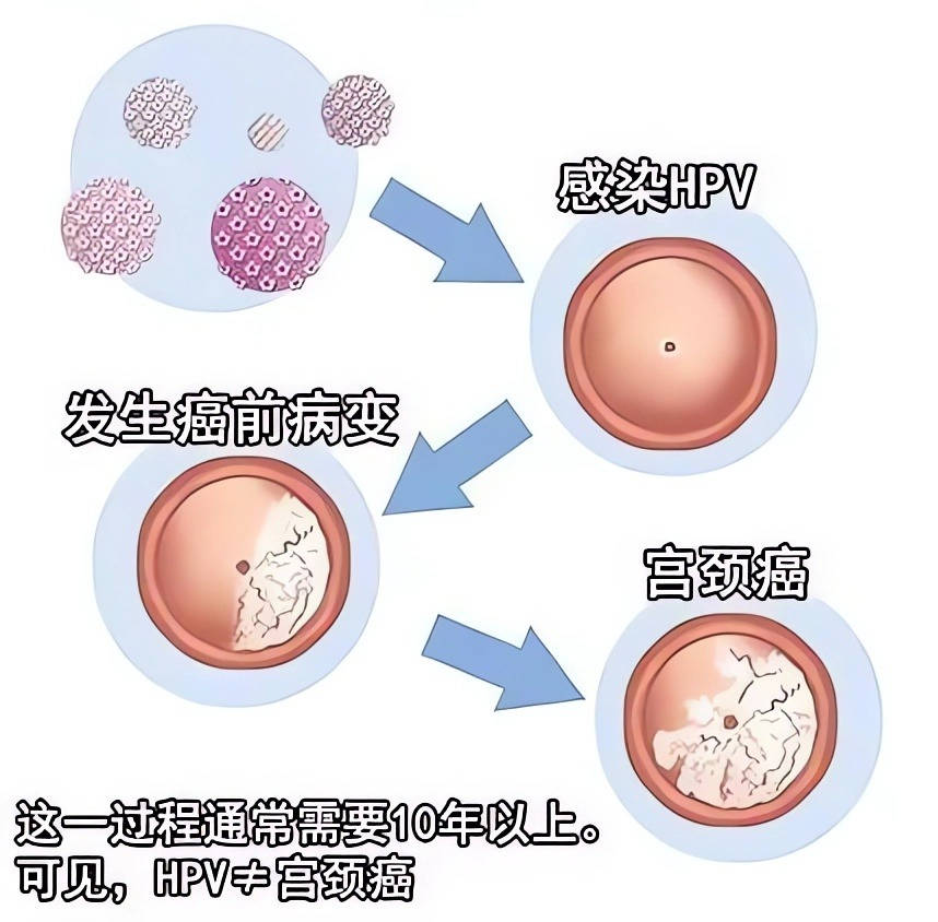 宫颈癌筛查图片怎么看图片