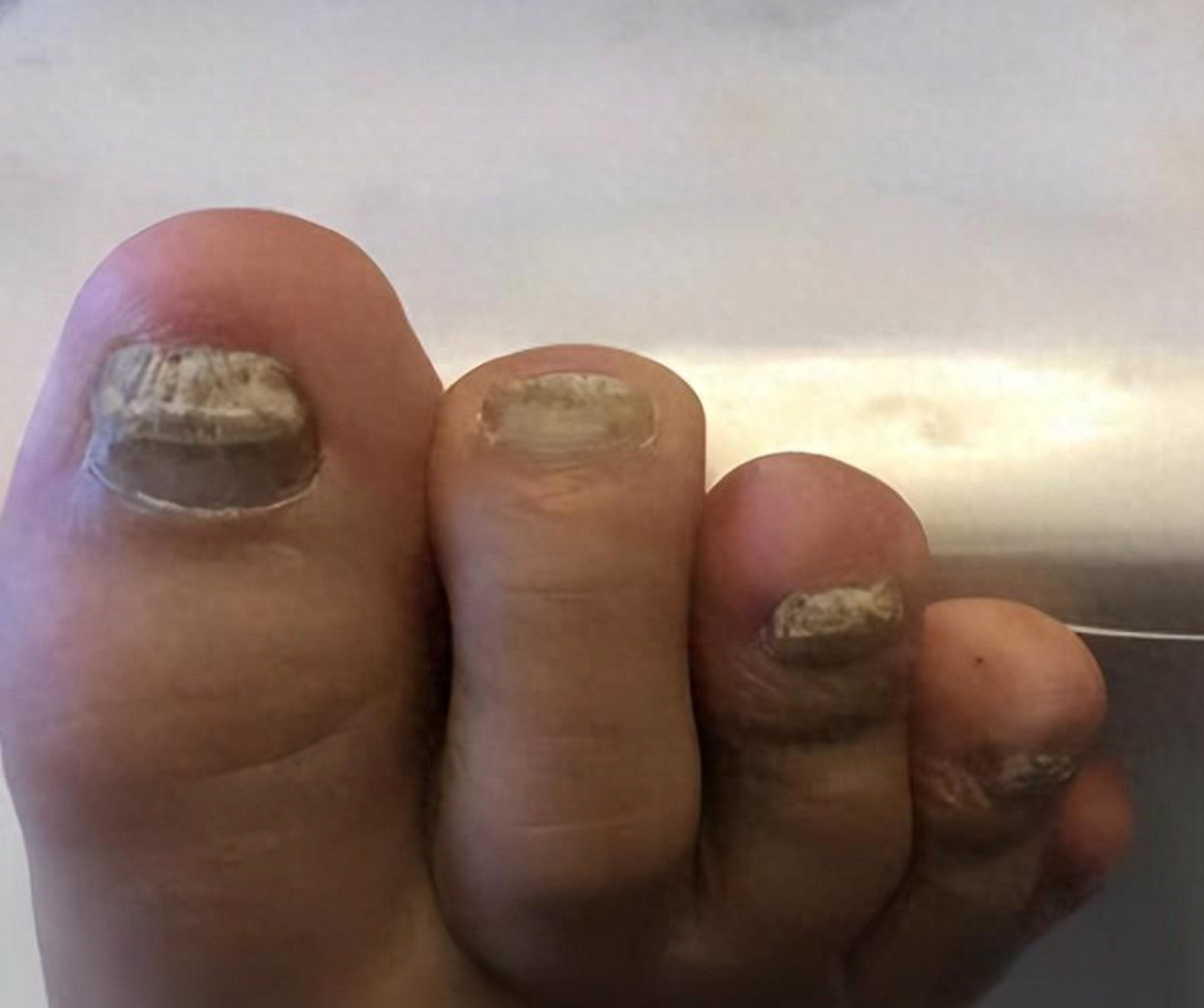 3个月根除泛黄增厚灰指甲!方法只说这一次!赶紧码住了!