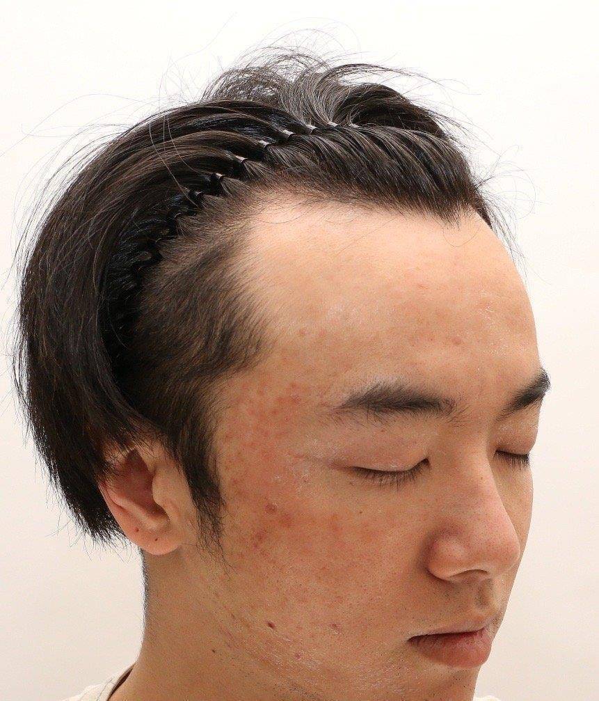 植发古装男子(男生植发发大概需要多少钱)
