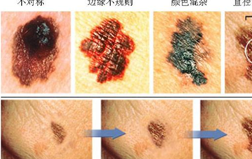 手上出现这个"黑点",可能是癌细胞"在试探",希望你没出现!