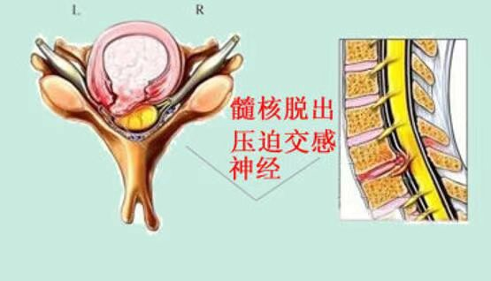 1,神經根型頸椎病:患者常會出現沿患側脊神經分佈的放射性疼痛,表現為