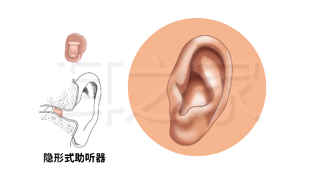 相對來說佩戴隱蔽,且貼合度高;2佩戴在耳道,能利用耳廓的解剖結構