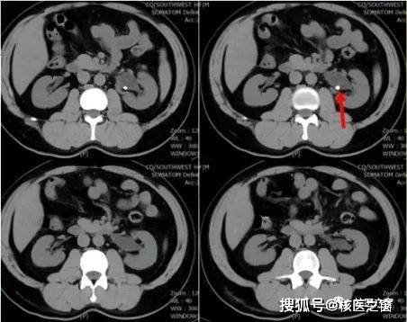 ct提示:左腎結石伴積水.左,右腎gfr分別約為46.6ml/min,45.