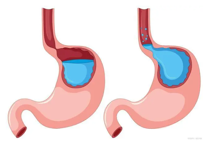 胃燒心是怎麼一回事?如何緩解症狀及治療?_胃酸_食管_的作用