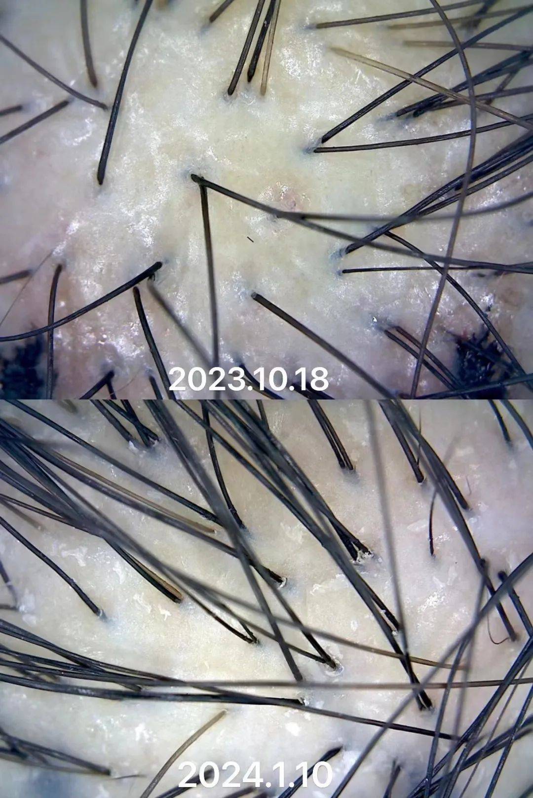 秃如其来年轻人为何都开始偏向毛囊克隆生发