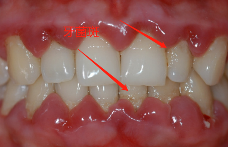牙周炎图片症状图片图片