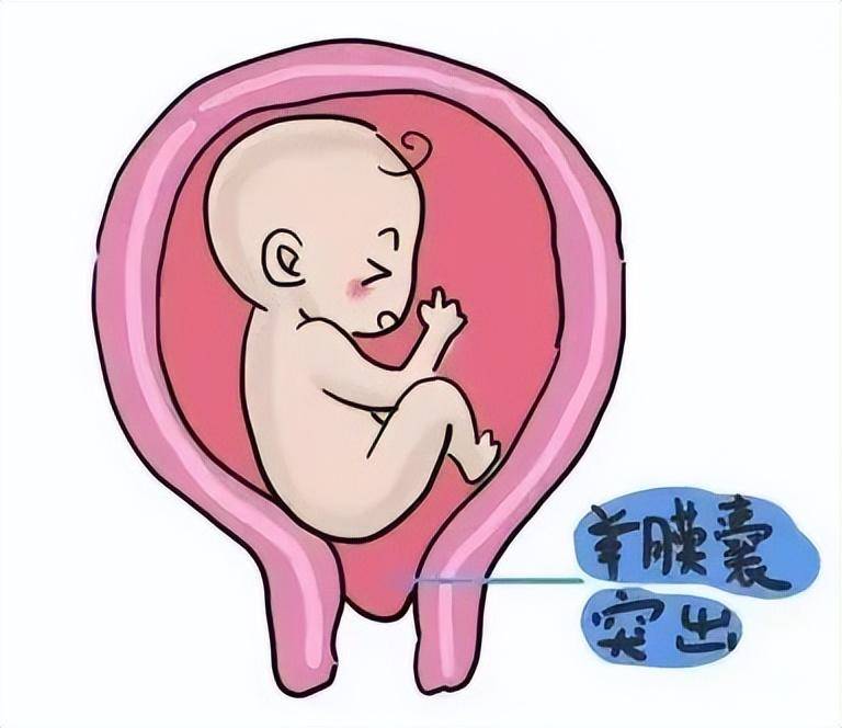 "宫颈环扎术"助孕妈喜迎新生命_岳阳县_手术_专业