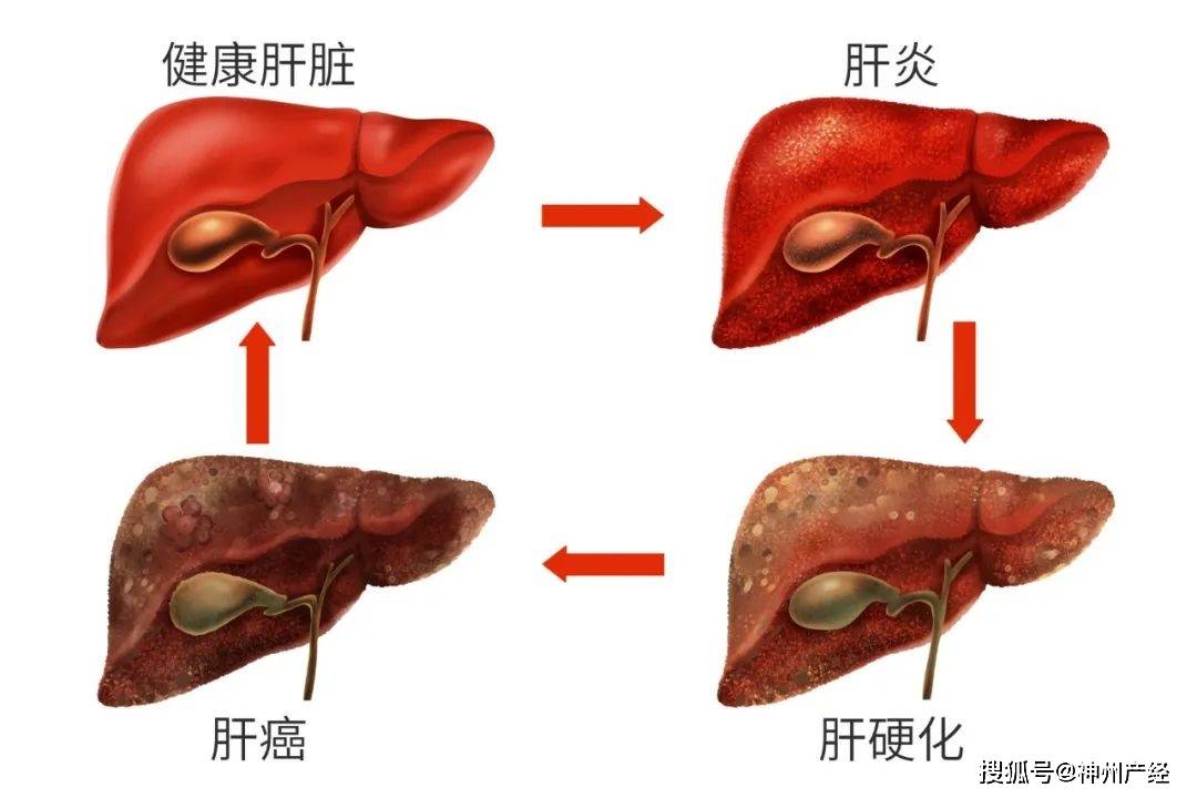 濟南京壇肝病醫院雙重活肝特色治療助力肝硬化患者