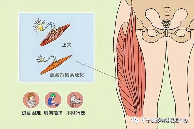 什麼是運動神經元疾病_肌肉_發病_症狀