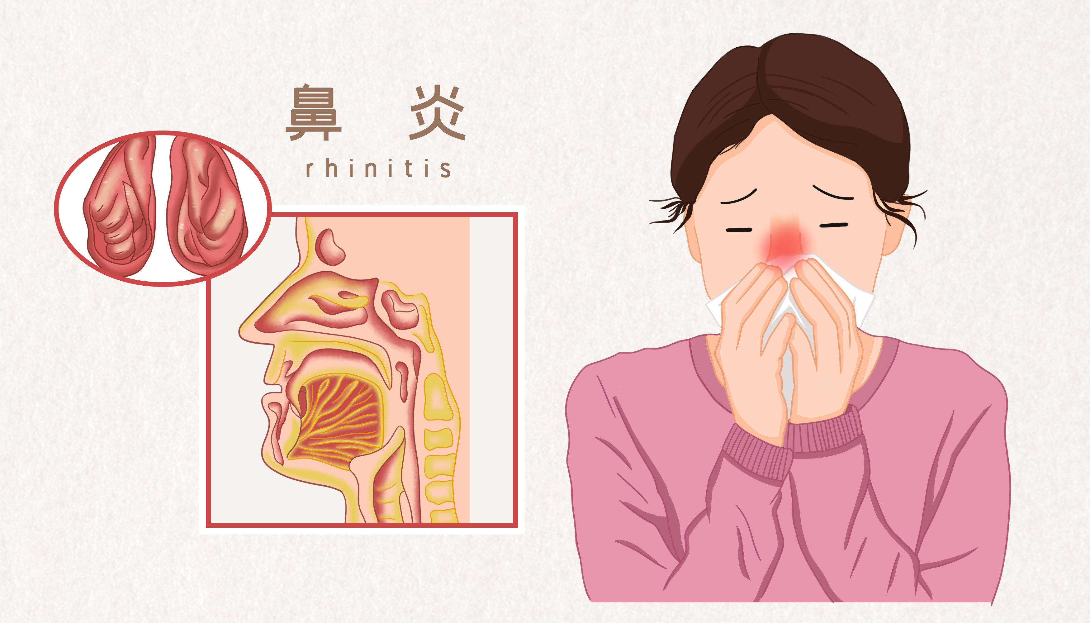 各种鼻炎的症状图片图片
