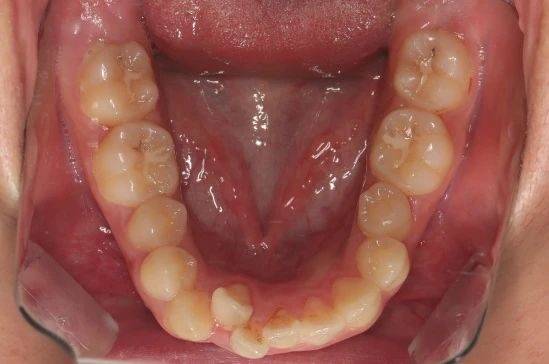 成人正畸必做的6大功课,了解清楚少走弯路!_牙齿_患者_成年