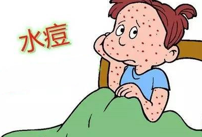 水痘和帶狀皰疹痊癒後還能復發嗎?_病毒_免疫力_症狀