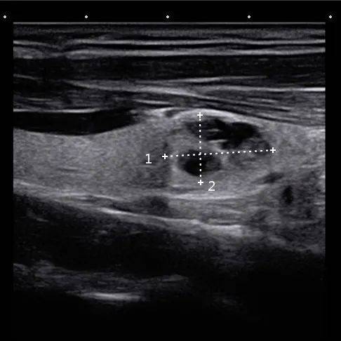 正常甲状腺彩超图片