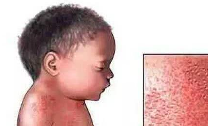 孩子湿疹可大可小,不但影响颜值还容易患上皮肤病!