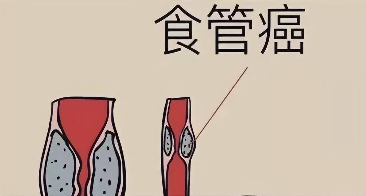 身体出现这些变化,可能是食管癌的预警!