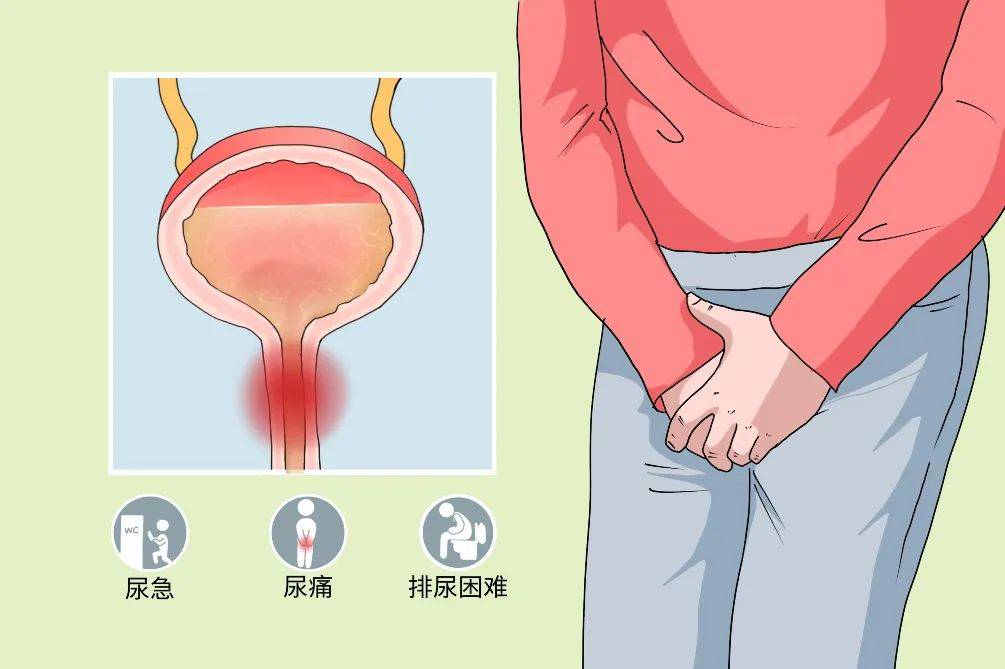 滴虫性阴道炎是由阴道毛滴虫感染引起的,主要表现为外阴瘙痒及白带