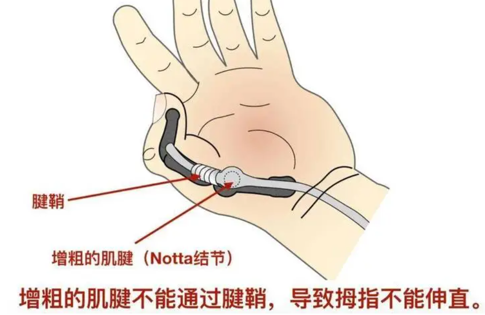 治疗_炎症_影响