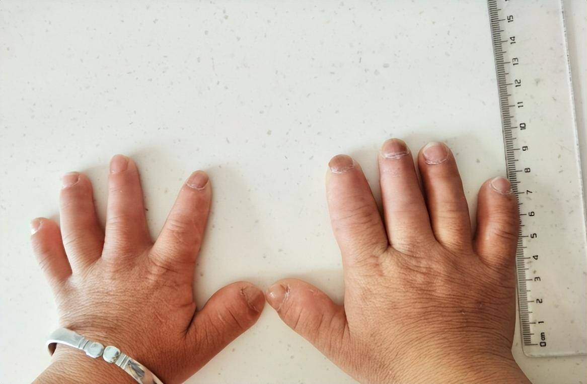 与此同时,段宣初院长表示,袁女士自身患有will-marchesani综合征(wms)