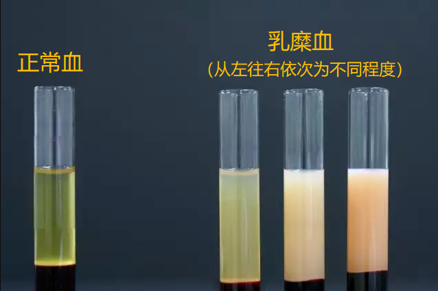 肝脏米老鼠征b超图图片