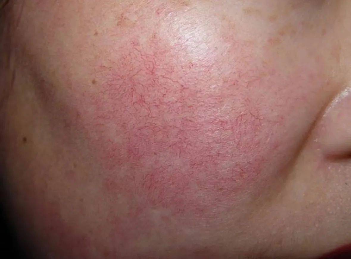 过来人曝光去红秘籍,在家操作更省钱!_皮肤_时间_运动