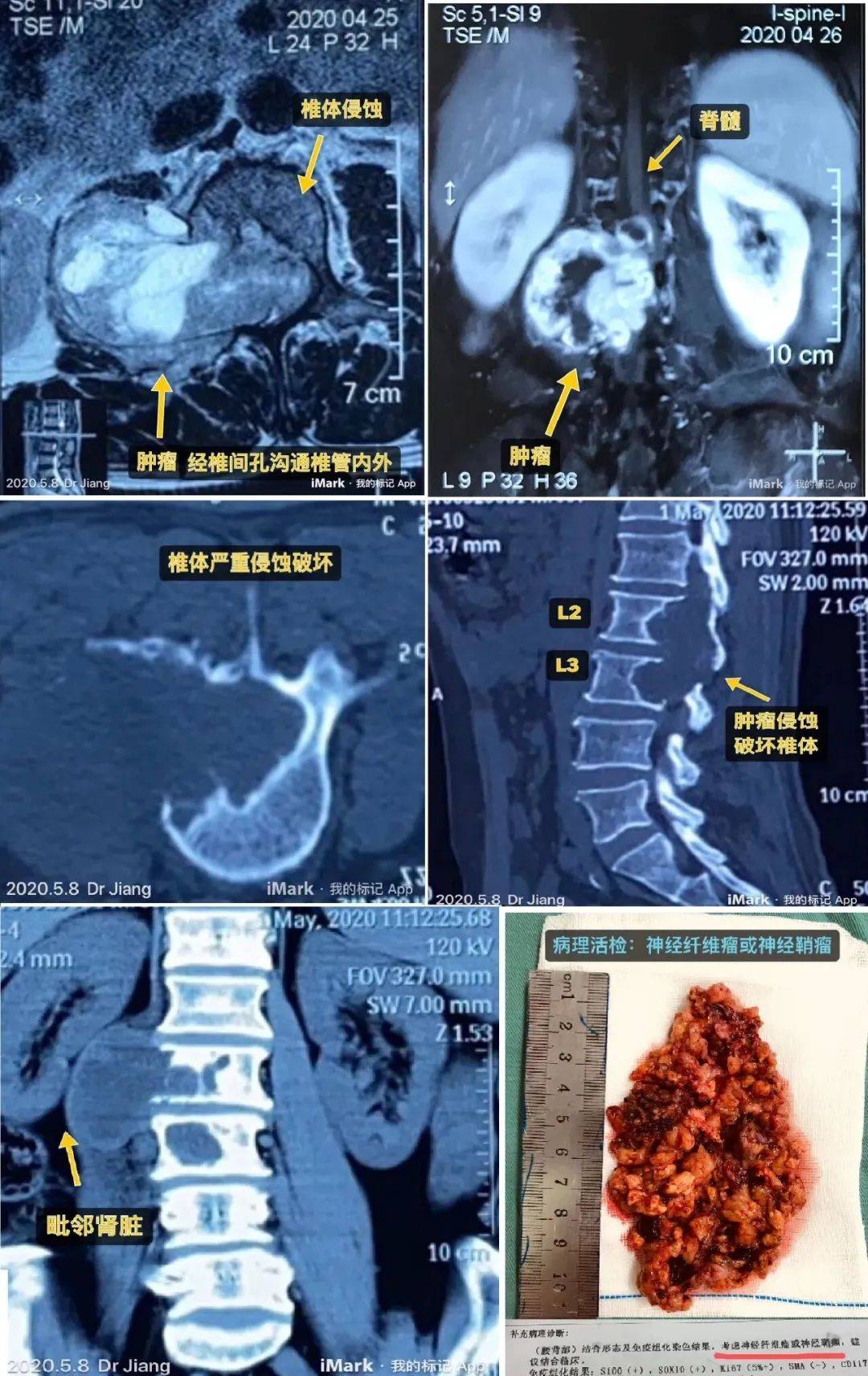 同时,马尾部位的肿瘤,如胆脂瘤,神经鞘瘤,脊髓脊膜瘤等,也可能对马尾