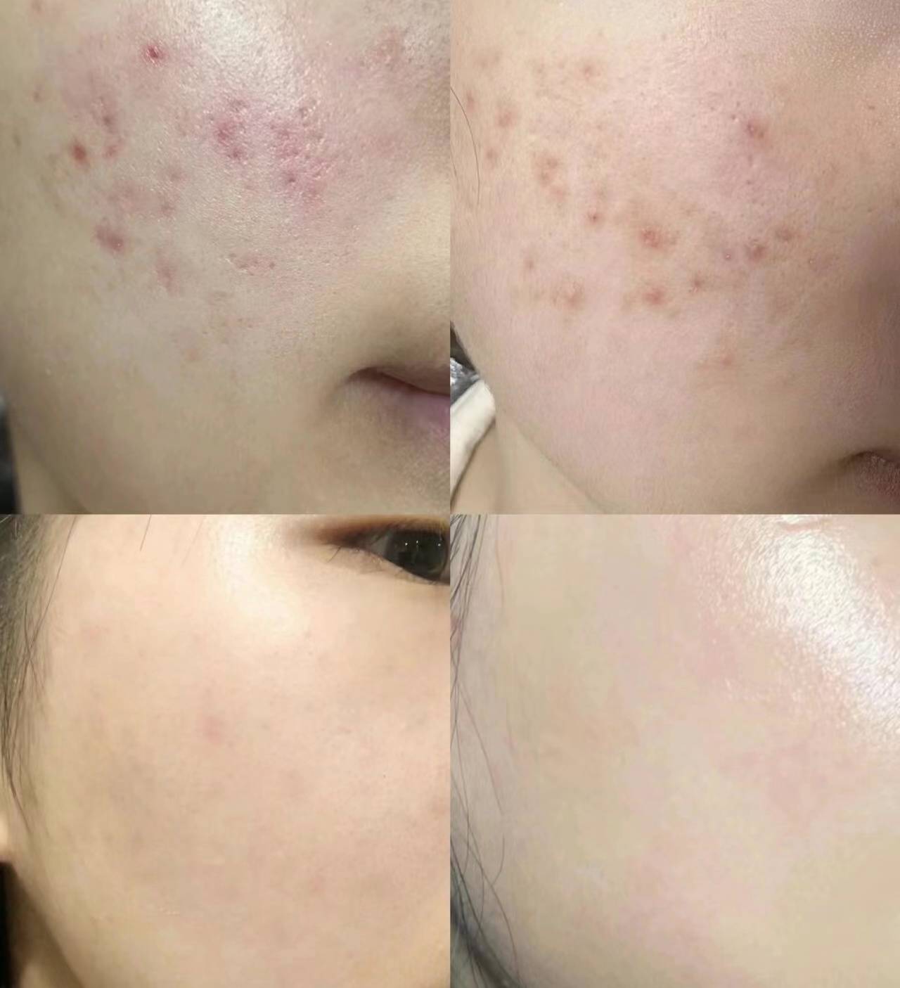 前后也后一个多月的时间,虽然价格有点小贵,但胜在效果非常好!