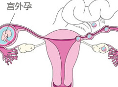 位置也不对,比如长在宫颈上的(宫颈妊娠),宫颈角上的(宫角妊娠或者间