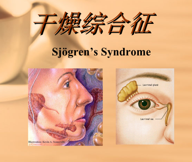 长沙皮肤病医院详解_干燥综合征的症状及预防方法_患者_护理_药物