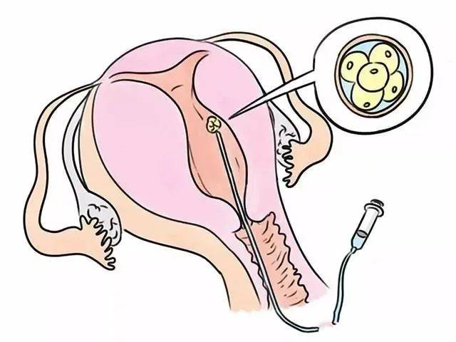 【今年有喜】试管婴儿只取到几个卵,原因竟然是这个!_卵泡_卵子_情况