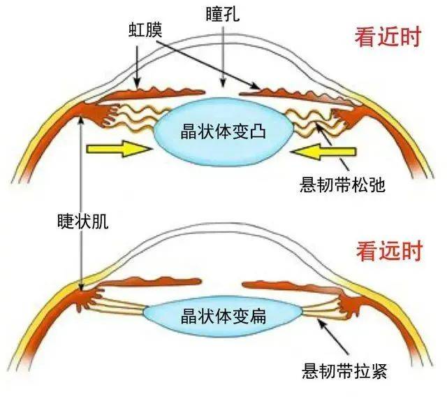 角膜塑形镜原理示意图图片