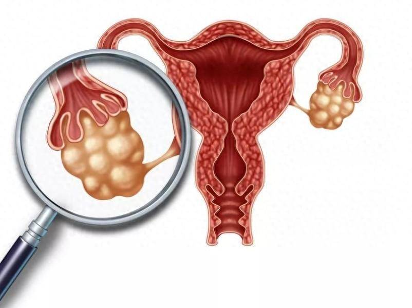 子宫肌瘤不可怕,及时治疗是关键!这3个治疗方法快来一