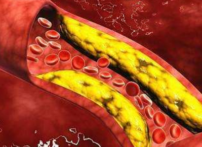 血液"垃圾"最怕它,这些食物坚持吃,血管一通到底,远离血管病_食用