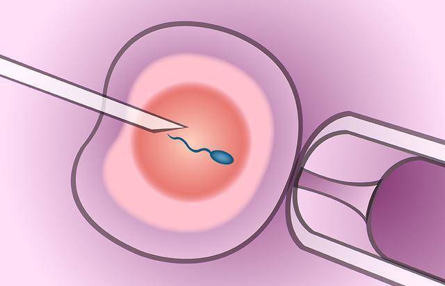 做試管嬰兒是怎麼樣取卵取精的呢?_精子_過程_醫生