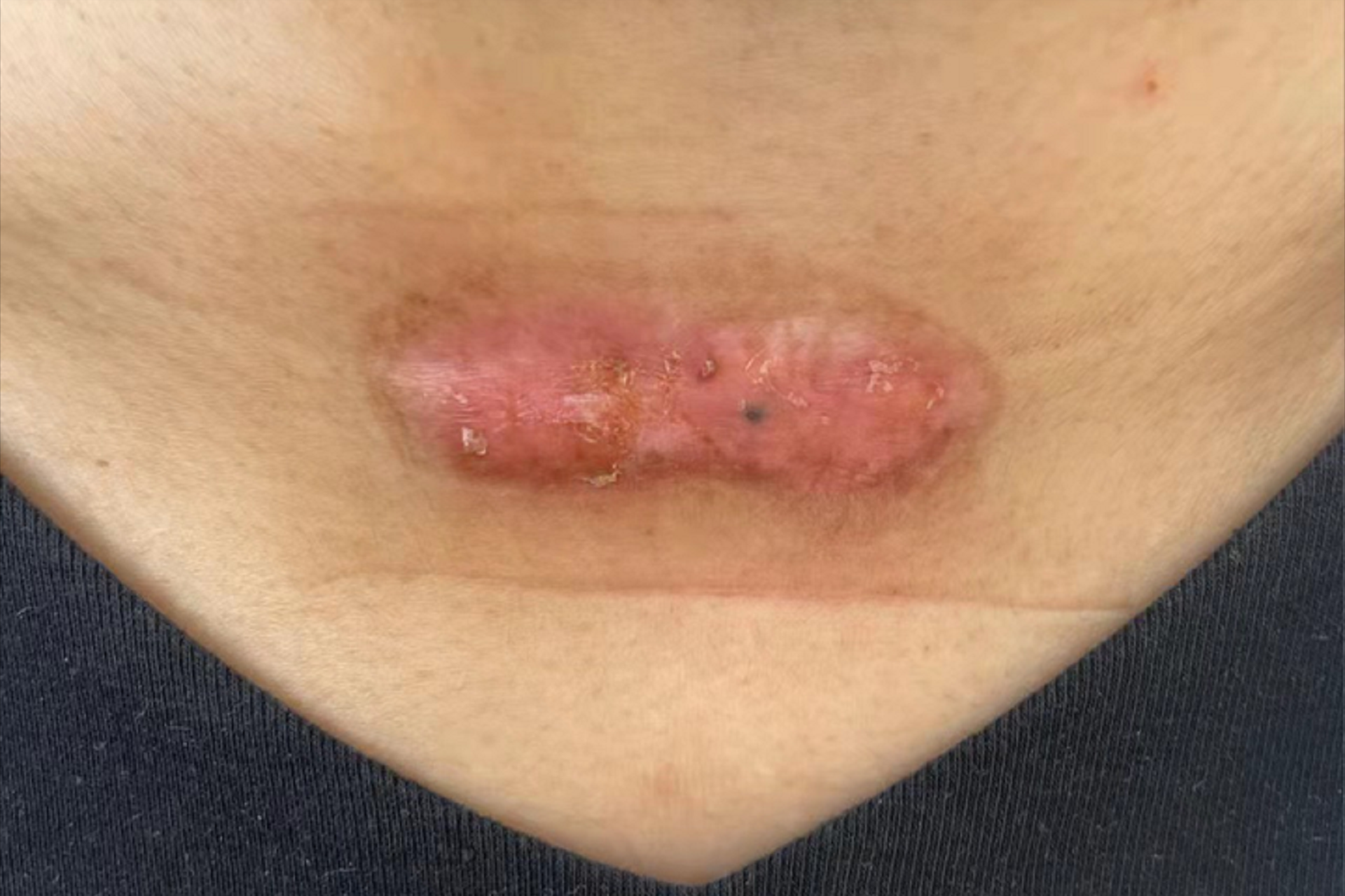 原来修复疤痕增生真的很简单!