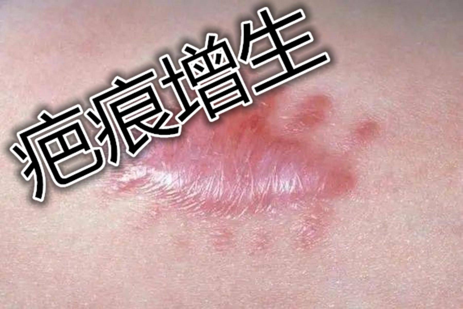 甲状腺手术留下的疤痕长久不消,这个方法我能吹爆!真的猛啊!