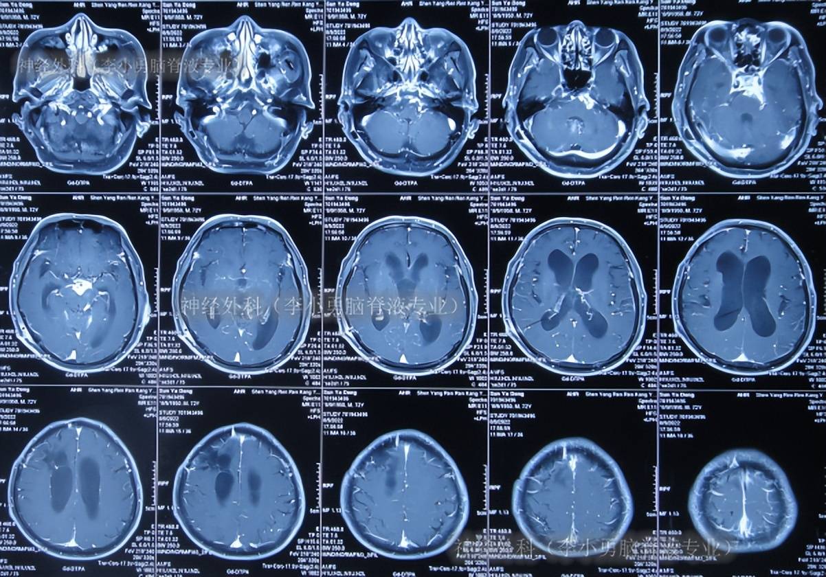 脑囊虫手术37年后的2年半中,脑积水分流术感染脑脊液内有6种细菌_治疗