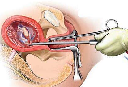 打胎一次对女人身体有什么危害(第一胎流产了对以后怀孕的影响)
