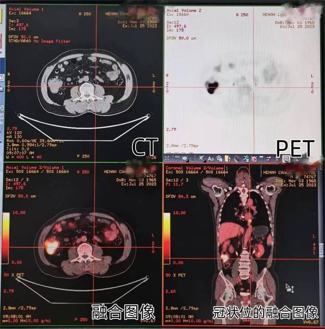 做完ct,为啥还要做pet-ct?肿瘤专家这样说._检查_王先生_代谢