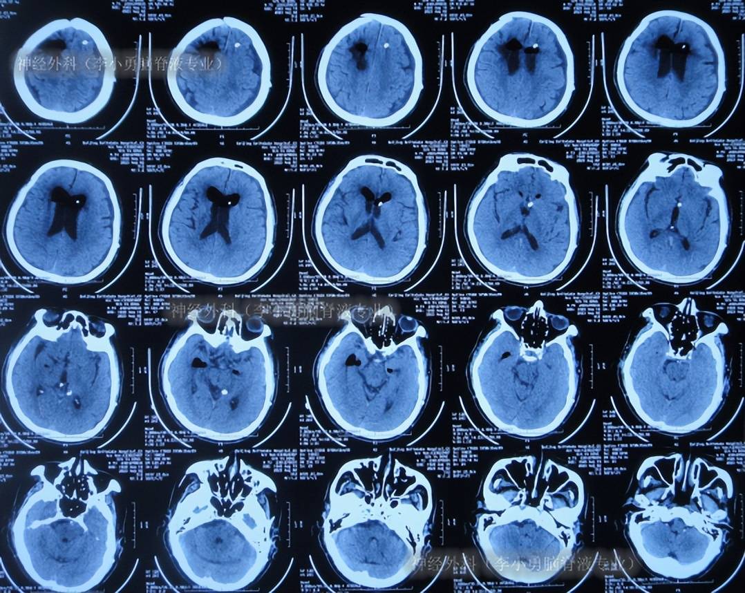 图-27:2023年8月2日颅脑ct脑脊液各项化验达标后于2023年8月17日,进行